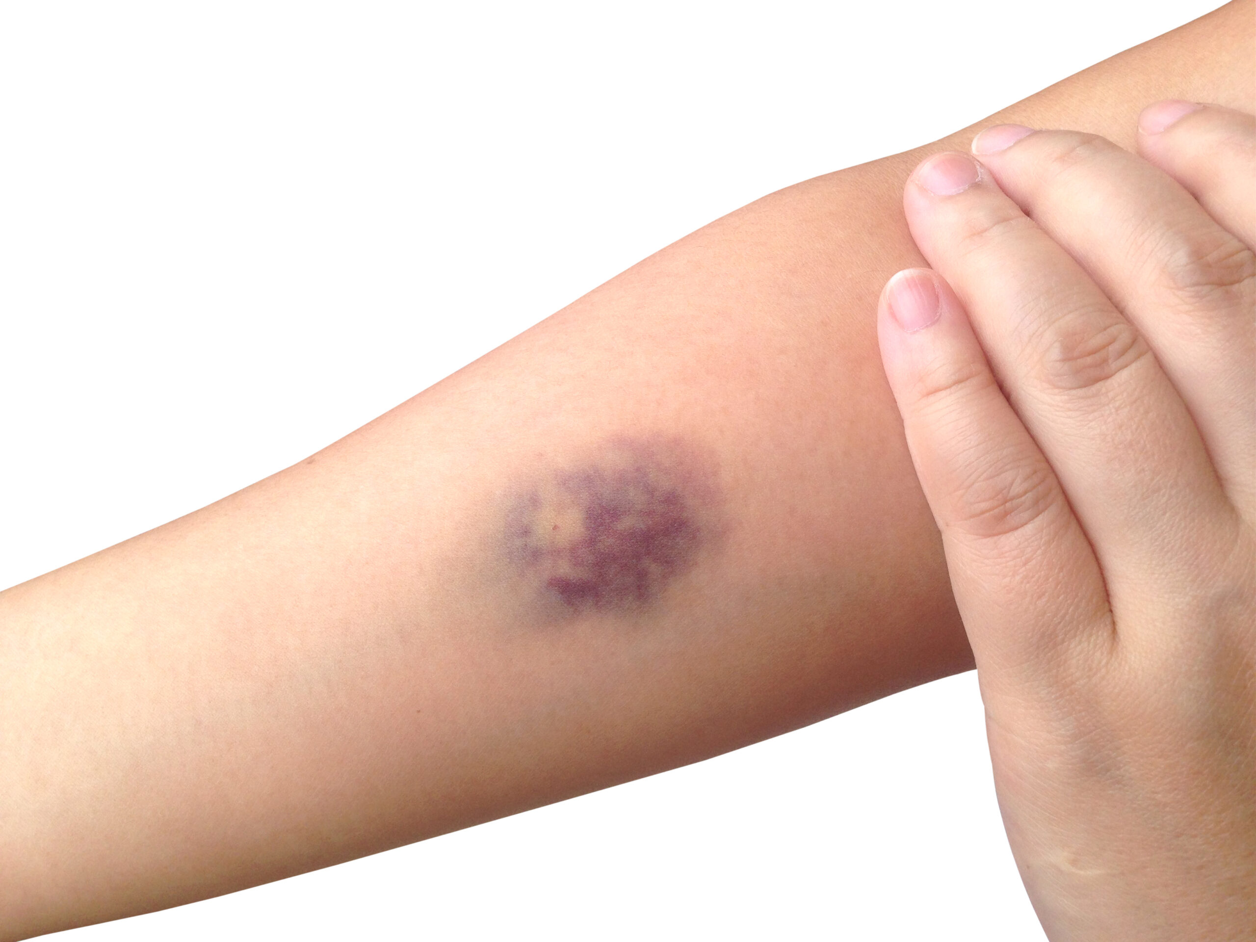 Soft Tissue Injuries